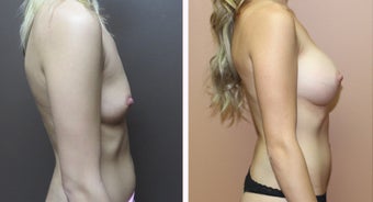 35-44 year old woman treated with Breast Augmentation after 3299919