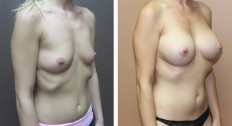 35-44 year old woman treated with Breast Augmentation before 3299919