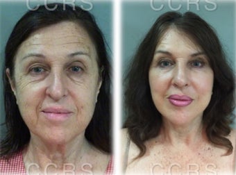 57 year old woman treated with SMAS Facelift / tip plasty before 3031510