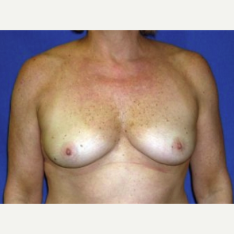 45-54 year old woman treated with Breast Augmentation before 3220139
