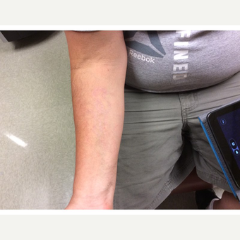Laser Tattoo Removal using the PicoSure laster; 35-44 year old man treated with using after 3292533