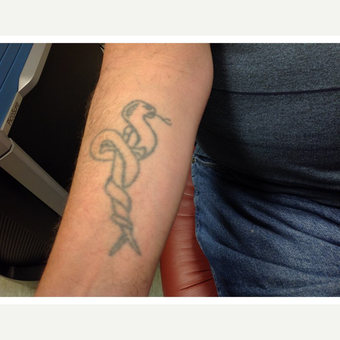Laser Tattoo Removal using the PicoSure laster; 35-44 year old man treated with using before 3292533