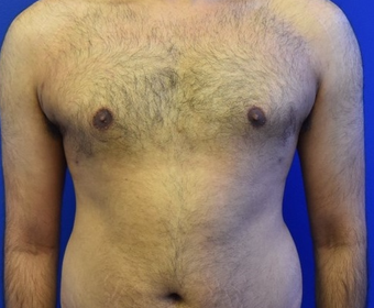 18-24 year old man treated with Laser Liposuction for Gynecomastia after 3483320