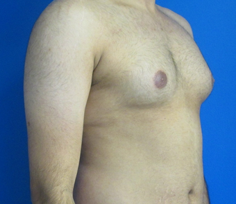 18-24 year old man treated with Laser Liposuction for Gynecomastia 3483320