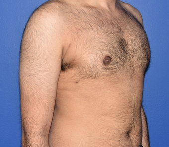 18-24 year old man treated with Laser Liposuction for Gynecomastia 3483320