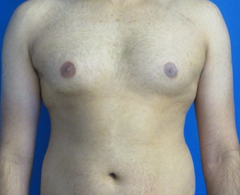 18-24 year old man treated with Laser Liposuction for Gynecomastia before 3483320