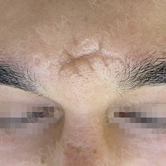 36 year old, scar treatment with RecoSMA before 3499196