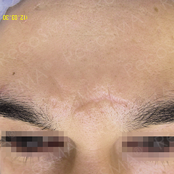 36 year old, scar treatment with RecoSMA after 3499196