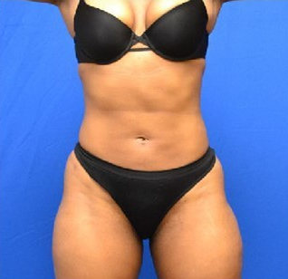 35 year old femal treated with SmartLipo to the abdomen and waist after 1508926