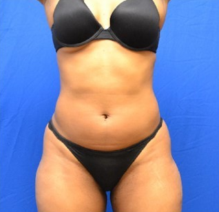 35 year old femal treated with SmartLipo to the abdomen and waist before 1508926