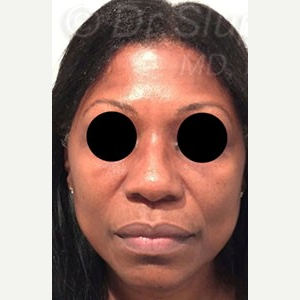 45-54 year old woman treated with Revision Rhinoplasty before 3788055