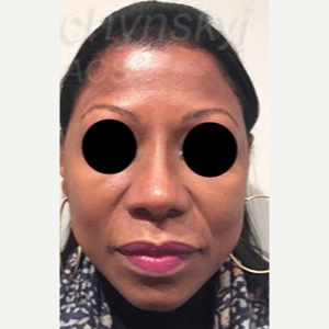 45-54 year old woman treated with Revision Rhinoplasty after 3788055