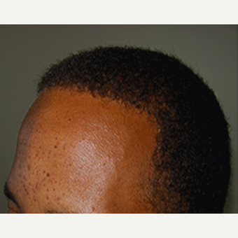 35-44 year old African American man treated with Hair Transplant after 3420693