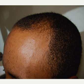35-44 year old African American man treated with Hair Transplant before 3420693