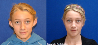 Ear Surgery before 1245294