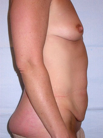 Mommy Makeover for 49 year old mother of many 1086448
