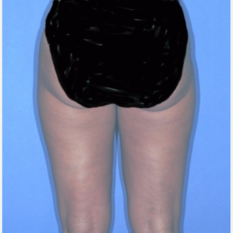 Liposuction after 3345988