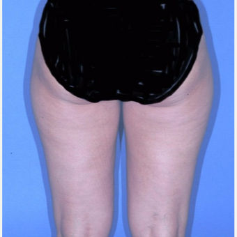 Liposuction before 3345988