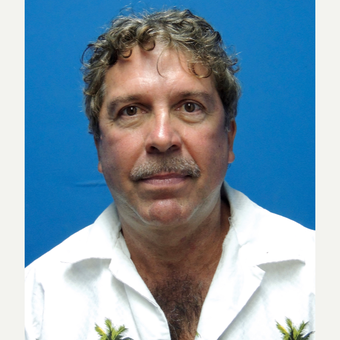 55-64 year old man treated with Facelift after 3704472