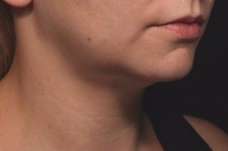 35-44 year old woman treated with Kybella after 1844569