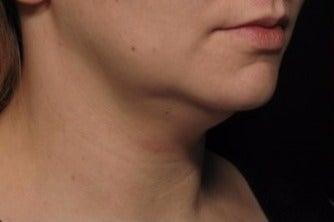 35-44 year old woman treated with Kybella before 1844569