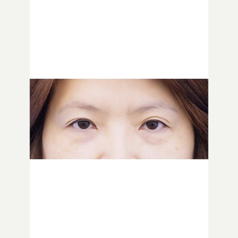45-54 year old woman treated with Fat Transfer before 3653611