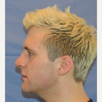 18-24 year old man treated with Rhinoplasty after 3191418