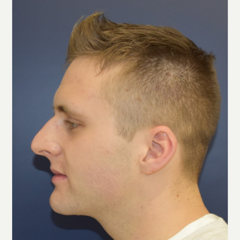 18-24 year old man treated with Rhinoplasty before 3191418