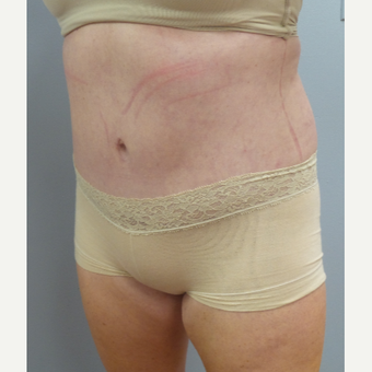 35-44 year old woman treated with Tummy Tuck after 3482525