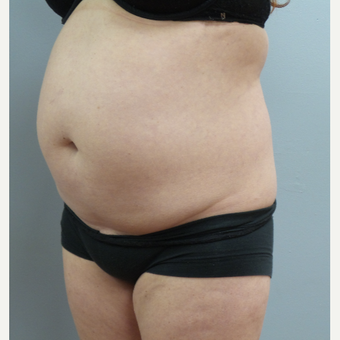 35-44 year old woman treated with Tummy Tuck before 3482525