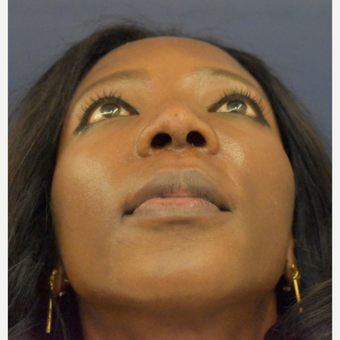 35-44 year old woman treated with Nose Surgery after 3288980