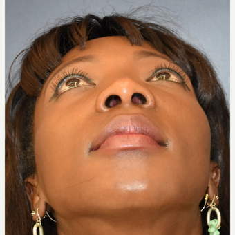 35-44 year old woman treated with Nose Surgery before 3288980