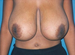 Breast Reduction before 1661938