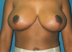 Breast Reduction after 1661938