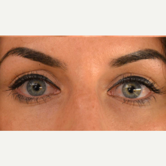 25-34 year old woman treated with Injectable Fillers after 2874629