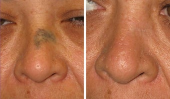 Mole Removal photos before 951879