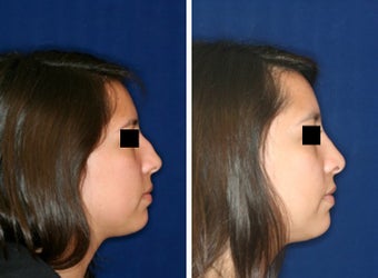 Nose Surgery before 1430820