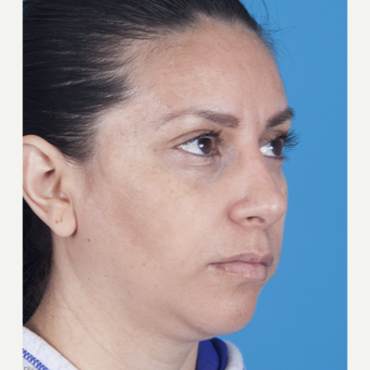 35-44 year old woman treated with Rhinoplasty after 3115230