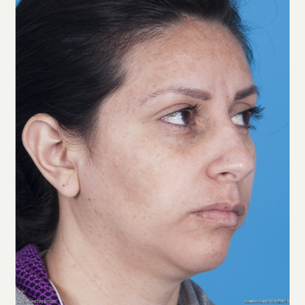 35-44 year old woman treated with Rhinoplasty before 3115230