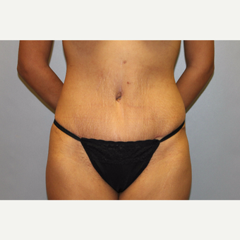 25-34 year old woman treated with Tummy Tuck after 3529318