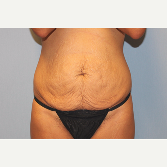 25-34 year old woman treated with Tummy Tuck before 3529318