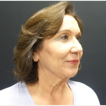 65-74 year old woman treated with Facelift before 3244835