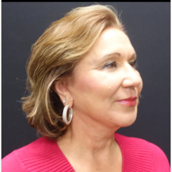 65-74 year old woman treated with Facelift after 3244835
