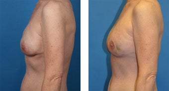 41 Year Old Woman, Cassileth One-Stage Breast Reconstruction after 1039917