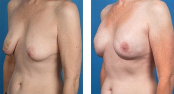 41 Year Old Woman, Cassileth One-Stage Breast Reconstruction 1039917