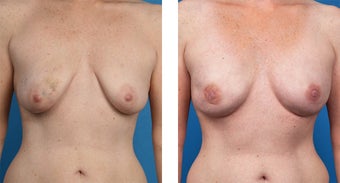 41 Year Old Woman, Cassileth One-Stage Breast Reconstruction before 1039917