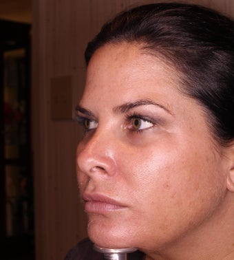 38 Year old female treated with Voluma in cheeks before 1433078