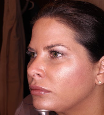38 Year old female treated with Voluma in cheeks after 1433078