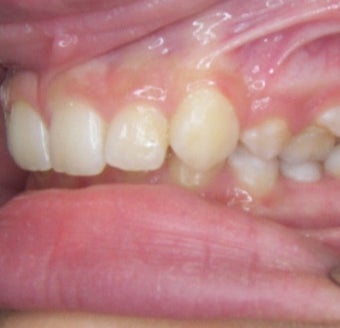 17 or under year old woman treated with Clear Braces before 1567770