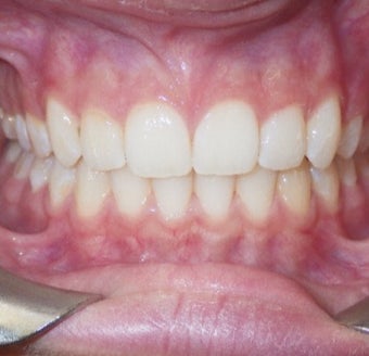 17 or under year old woman treated with Clear Braces 1567770